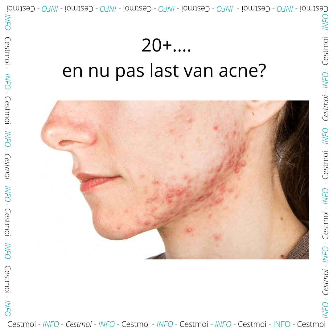 20-25+… en nog last van acne? Echt héél vervelend!
