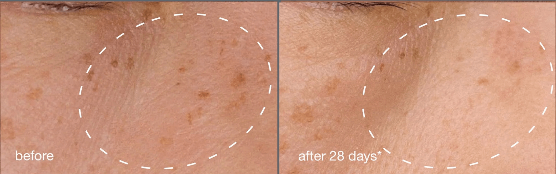 Waarom dit het perfecte moment is om pigmentvlekken aan te pakken: oorzaken en oplossingen